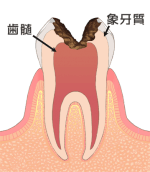 虫歯4
